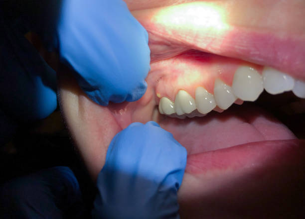 Best Emergency Wisdom Tooth Extraction in Shasta Lake, CA