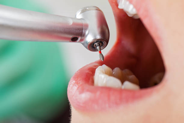 Best Emergency Wisdom Tooth Extraction in Shasta Lake, CA